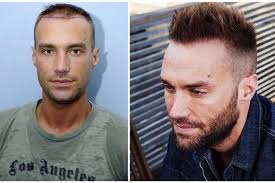 Calum Best Has His Second Fue Hair Transplant To Add Density Results Should Be Fully Visible In 6 Best Hair Transplant Hair Transplant Surgery Help Hair Loss