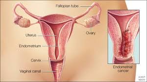 What are the types of ovarian cancer? Mayo Clinic Endometrial Cancer Which Begins In The Uterus Within The Layer Of Cells That Form The Uterine Lining Has Been On The Rise Over The Past Decade Each Year In