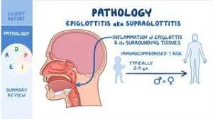 Image result for Epiglottitis