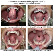 Image result for Ankyloglossia