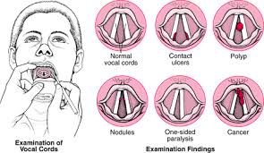 Chart To See Types Of Vocal Chord Problems Speech