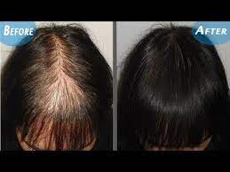 Magical Hair Re Growth Serum 100 Effective For He Amp She One Odd Trick To Regrow Your Hair In Days Y Thick Hair Remedies Hair Fall Remedy Hair Remedies