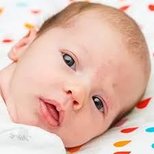 Image result for Nevus Simplex