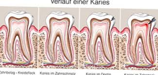 Inilah 8 efek buruk yang berkemungkinan dialami sehingga patut untuk diketahui. Gigi Mati Punca Gejala Rawatan Penyakit