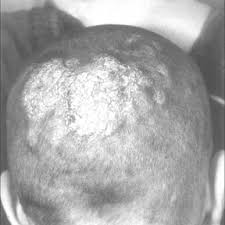 It is caused by a fungus that can live on skin, surfaces like gym. 3 Tinea Capitis Ringworm Of Scalp Obtained From A Child Patient Download Scientific Diagram