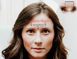 Before and After Using Dysport