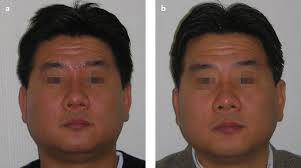 Fda approved nd yag cynosure laser technology. 28 Aesthetic Laser Hair Removal For The Asian Face Plastic Surgery Key