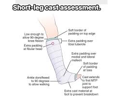 Image result for Short Leg Cast
