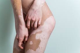 Weisse Flecken Auf Der Haut Kann Man Vitiligo Behandeln Besser Gesund Leben