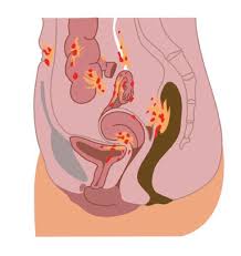 Onder degenen met endometriose is ongeveer 40% onvruchtbaar. L Endometriose Toi Mon Endo