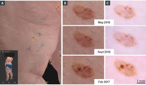 Subungual melanoma is a rare form of cancer that develops underneath the fingernail or toenail. Racgp Diagnosis And Management Of Cutaneous Melanoma