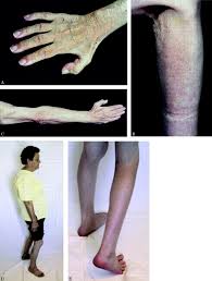 Pictures of muscle atrophy in legs. A New Dominant Distal Myopathy Affecting Posterior Leg And Anterior Upper Limb Muscles Neurology