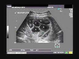 Gravida Acredita Que Esta Esperando Gemeos Mas No Ultrassom Medico Ve Algo Incrivel