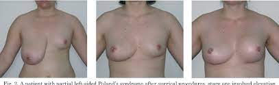 Poland syndrome, thoracic wall deformity, lipomodeling, fat grafting, autologous breast reconstruction. Figure 2 From Surgical Treatment Of Patients With Poland S Syndrome Own Experience Semantic Scholar