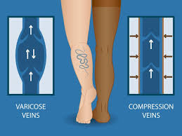 Thewriter send an email august 14, 2019. 8 Ways To Get Rid Of Varicose Veins At Home