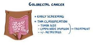 Image result for Colorectal Cancer