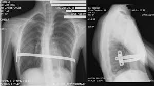 Nuss Procedure Pectus Excavatum Better Braces Echocardiogram