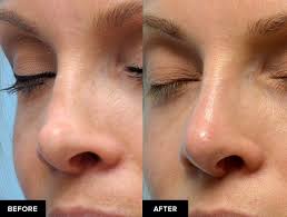 Eyeglass socks for nose dents. Nonsurgical Revision Rhinoplasty In San Francisco Dr David Mabrie Mabrie Facial Institute