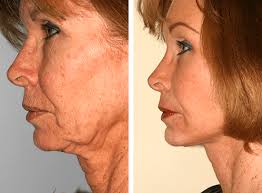 Neck Lift Surgery Near Me