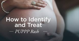 Image result for pruritic urticarial papules and plaques of pregnancy