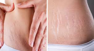 If you are looking to get rid of your stretch marks and improve the overall appearance of your skin then we have the expertise i have been under going a course of stretch marks treatment in premier laser clinic fulham, after only one session, my condition has improved. Stretch Mark Removal Inverness