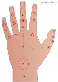 Image result for Hand Extensor Tendon Injury