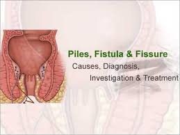 Treatment for fistula varies depending on the cause and extent of the fistula, but often involves surgical intervention combined with antibiotic therapy. Piles Fissure Fistula Symptoms Causes And Treatment In Bangalore