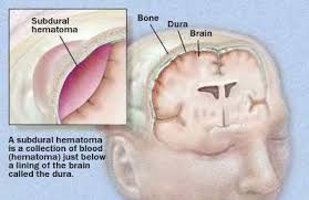 Hrithik Roshan Brain Surgery What Is Chronic Subdural Haematoma Thehealthsite Com Hrithik roshan wants to turn writer.