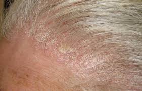 Image result for dry scabs on the head in children
