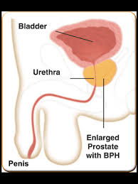 I went to a urologist last month for the 1st time (i finally have med. Benign Prostate Hyperplasia Bph Upper East Side New York Ny Advanced Urological Care Pc
