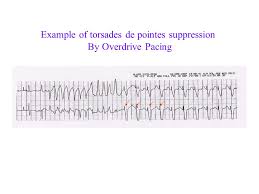 Synonyms for overdrive pacing in free thesaurus. Ventricular Arrhythmias Ppt Video Online Download