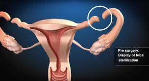 Tubal Ligation Reversal Tubal Reversal Fallopian Tubes Reverse