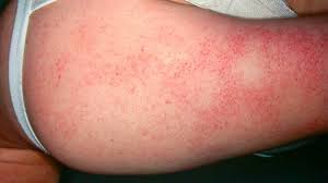 Why Do I Have Bumps On My Arms Causes And Treatments