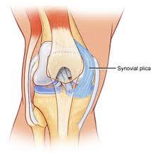 Plica Syndrome - Physiopedia