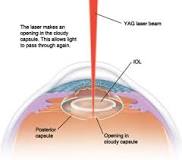 Image result for what is yag laser treatment for the eye?