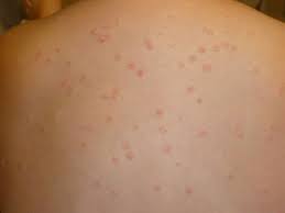 Image result for psoriasis