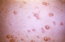 Rather it could be either due to some allergic reaction or a low platelet count. Shingles Breastfeeding Cdc