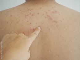 Image result for sweat rash on back