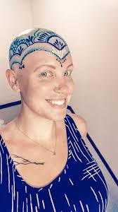 Alopecia universalis is a condition in which there is complete loss of hair on the scalp and also all over the body. Alopecia Universalis Alopecia My First Wig Alopecia Universalis