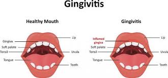 How To Get Rid Of Gingivitis Fast Gum Disease Treatment Gum Disease Gingivitis