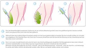 Gefahren und risiken von viszeralfett. Fettabsaugen Bauch Bilder Information Problemzonen