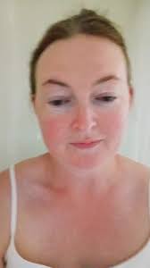 Nurse Jackie Irish Leg Rash