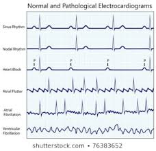 Normal Ecg Images Stock Photos Vectors Shutterstock