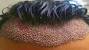 Bad Ingrown Hairs After Brazilian Wax