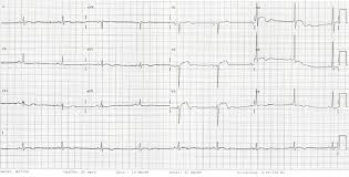 Im ekg können die bei einer herzmuskelentzündung erhöhte herzfrequenz und möglicherweise auch herzrhythmusstörungen sichtbar sein. Ekg Bei Perikarditis Fokus Ekg