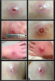 And here's when you should see a doctor. Beware Brown Recluse Spider Bite Think Safe Blog