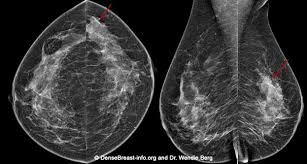 Imaging and lobular breast cancer. Mammography 3d Mammography Tomosynthesis Densebreast Info Inc