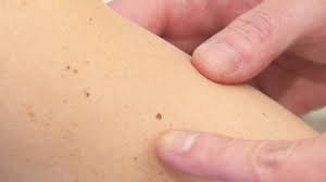 Melanoma is a type of skin cancer which begins in skin cells called melanocytes and affects more than 53,600 people in the united states each year. Preventing Skin Cancer New Technology Helps Track Moles Over Time Ctv News