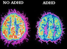 Good Intentions Won't Cure Adhd - Indy's Child Magazine