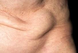 Image result for Inguinal hernia man